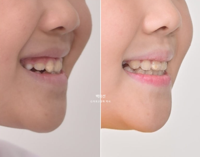 소아 비대칭 교정 인비절라인 퍼스트 재제작 1회 MA 치료 관련 이미지 16
