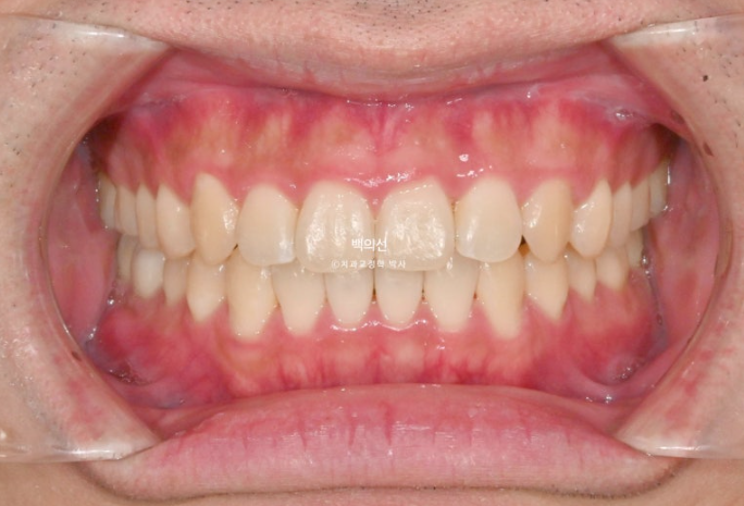 가위교합 나비치아 미니스크류 덧니 교정 인비절라인 라이트 관련 이미지 16