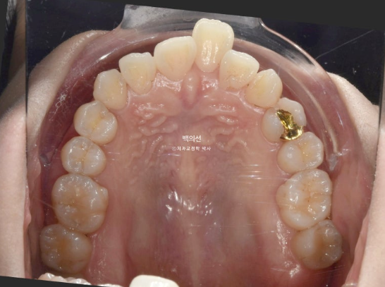 30대 돌출입 덧니 교정 인비절라인 발치교정 후기 관련 이미지 4