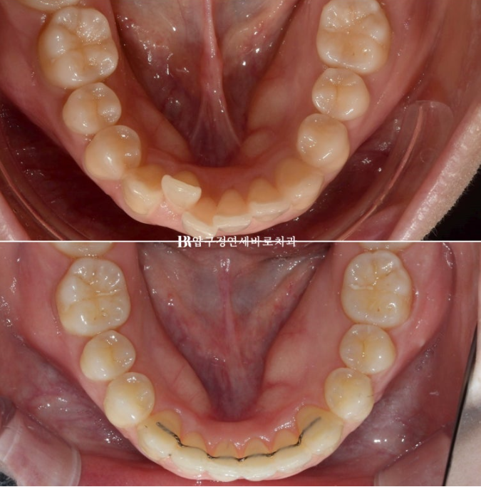Actual Case of Treating Congenitally Missing and Peg-Shaped Teeth Without Implants image 15