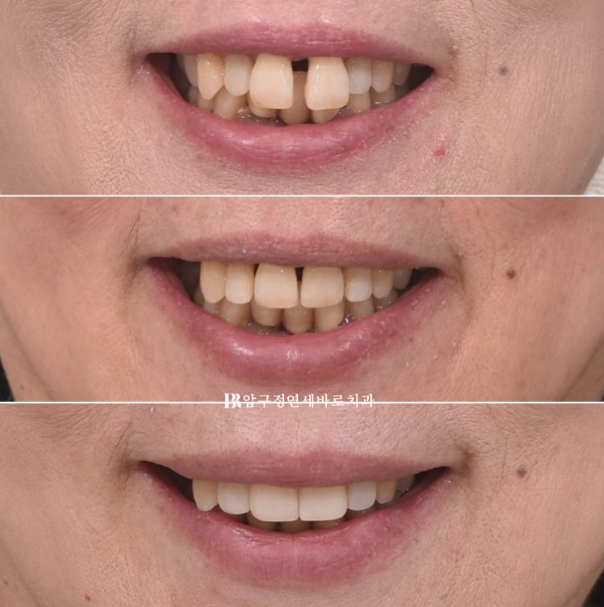 60대도 가능할까? 치주염&middot;벌어진 앞니를 살린 무삭제 라미네이트 치료 이야기 관련 이미지 11