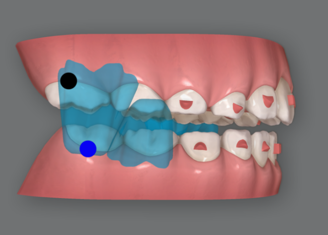 무턱교정 어린이 투명교정 인비절라인 퍼스트 교정 후기 관련 이미지 9