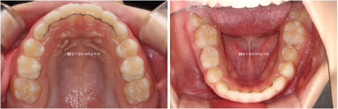 A Child’s Protruding Teeth Correction Review: Difficulty Closing the Lips image 13