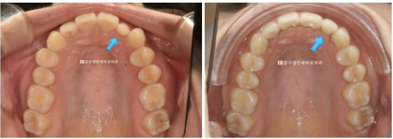 급속 교정 앞니부분교정 치료 무삭제 라미네이트 후기 관련 이미지 10