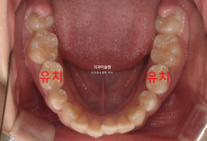 돌출입 비발치 어린이 교정 입술부전증 호두주름 호두턱 토끼이빨 인비절라인퍼스트 관련 이미지 5