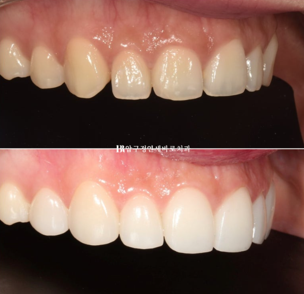 Before and After Non-Prep Veneers: Improving Gaps Between the Front Teeth and the Smile Line Together image 11
