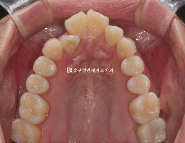 예비신부 교정 단기 앞니 부분교정 치료기간 6개월 관련 이미지 6