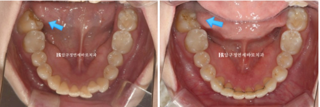 Can Invisalign Lite Work for Patients in Their 40s? A Real Case Improving Scissor Bite and Deep Bite in 10 Months image 17