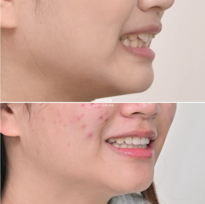 유학생 치아교정 해외거주 한국에서 치아교정? 관련 이미지 20