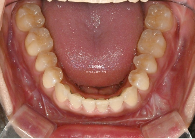 선수술 양악수술 비대칭 주걱턱 잇몸미소 치료 인비절라인 라이트 관련 이미지 16