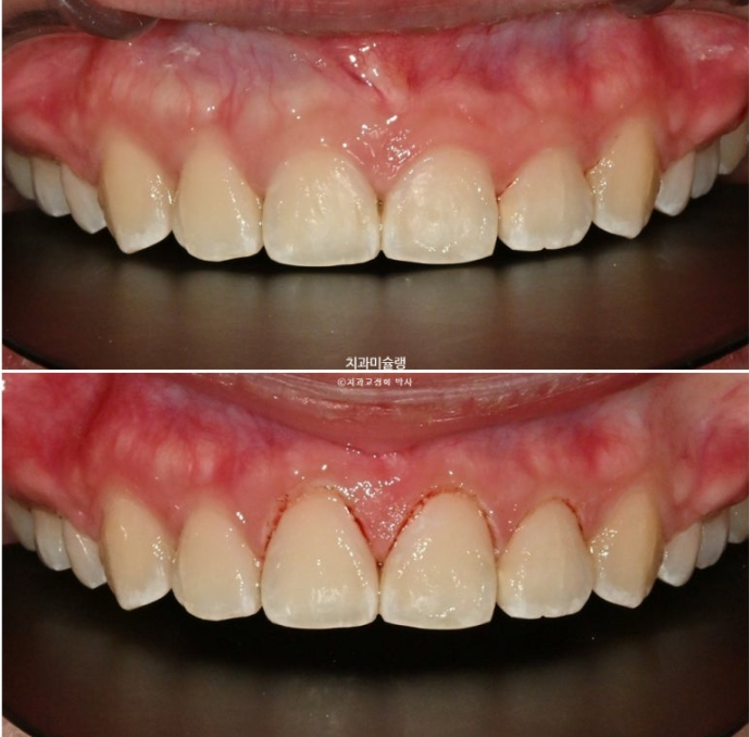 잇몸미소 거미스마일 치료 옥니 교정 잇몸성형 후기 관련 이미지 12