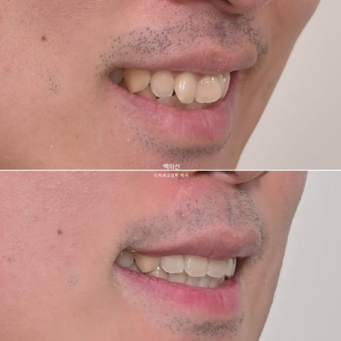 가위교합 나비치아 미니스크류 덧니 교정 인비절라인 라이트 관련 이미지 23