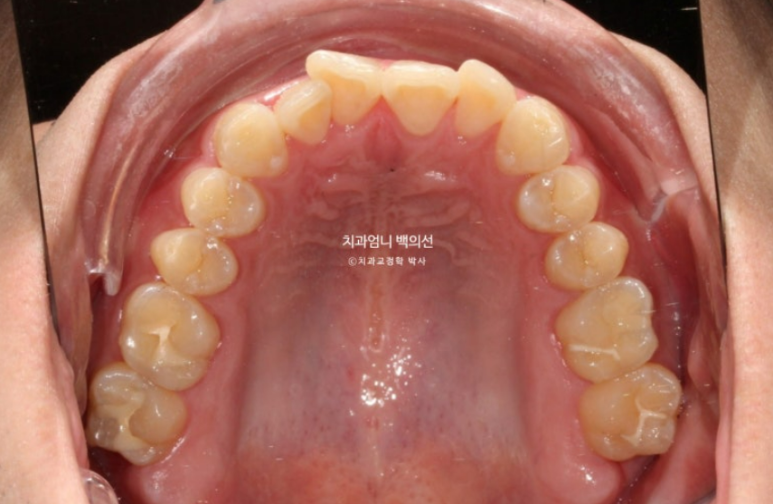 앞니 부분교정 덧니 교정 블랙트라이앵글 부정교합 마모 시뮬레이션 치료기간 5개월 관련 이미지 4
