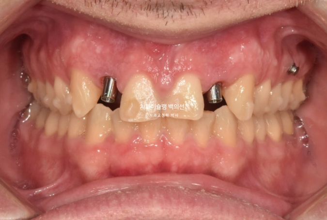 앞니 선천적 결손 인비절라인 임플란트 과개교합 치료 기간 관련 이미지 18