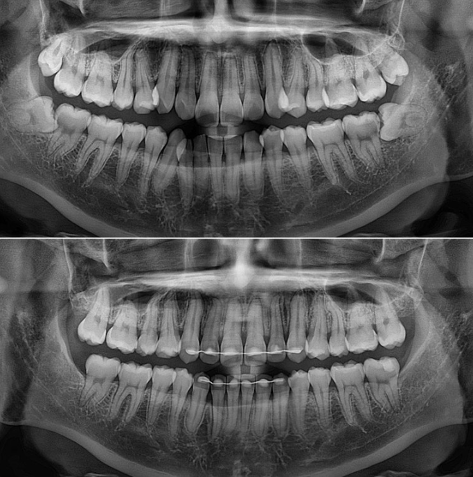 인비절라인 비발치 토끼이빨 교정 덧니 교정 치료기간 1년 8개월 관련 이미지 18