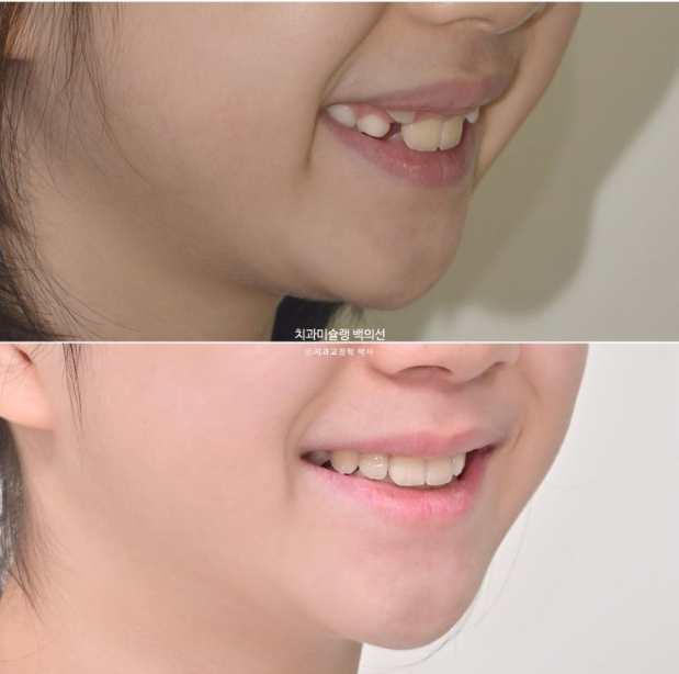 어린이 무턱 성장교정 덧니 인비절라인 퍼스트 악궁확장 치료기간 2년 관련 이미지 34