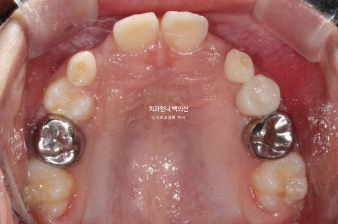 어린이 교정 인비절라인 퍼스트 비대칭 반대교합 어린이 성장 교정 관련 이미지 7