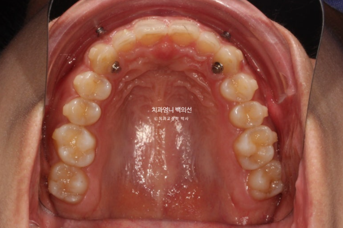 과개교합 옥니 거미스마일 교정 인비절라인 라이트 잇몸성형 후기 관련 이미지 9