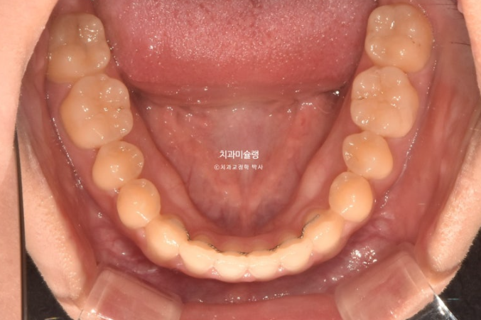 비발치 비수술 주걱턱 반대교합 재교정 치료 관련 이미지 12