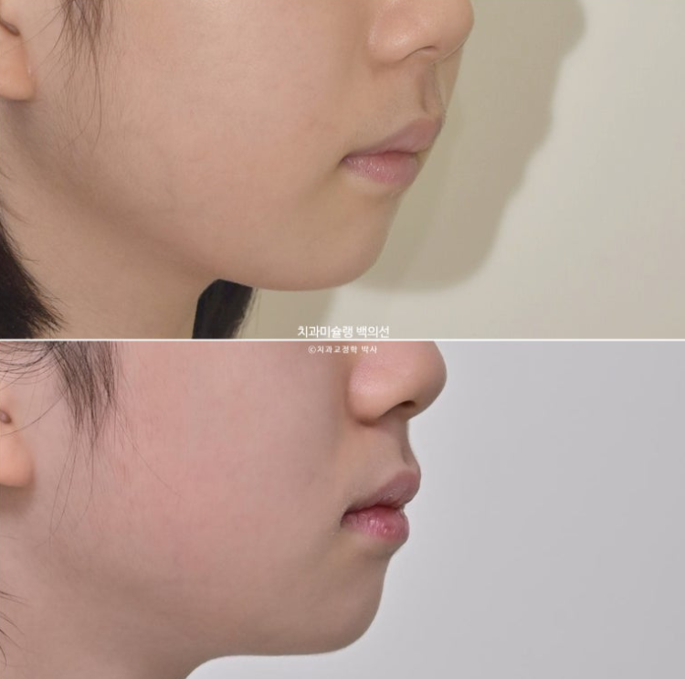 어린이 무턱 성장교정 덧니 인비절라인 퍼스트 악궁확장 치료기간 2년 관련 이미지 1