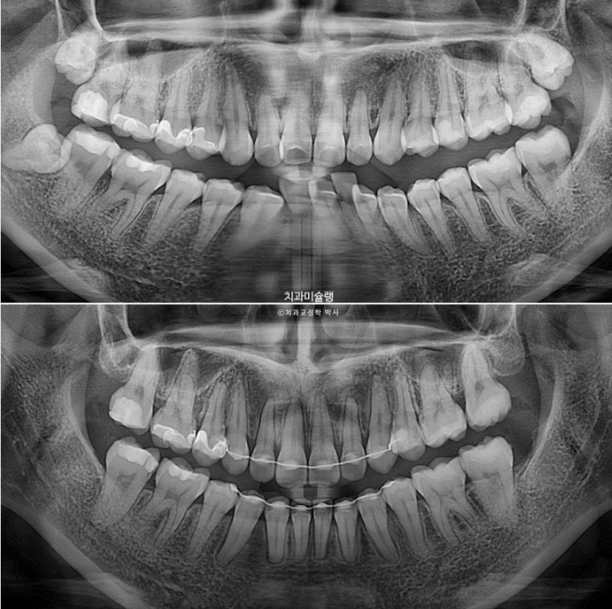 심한 돌출입 입술부전증 호두주름 발치교정 치료 관련 이미지 20