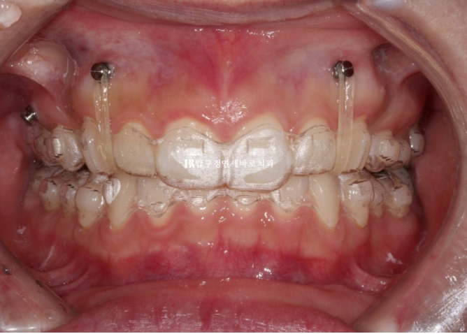 Does Invisalign Prevent Root Movement? Before-and-After Comparison of Extraction Treatment for Protruding Lips image 4