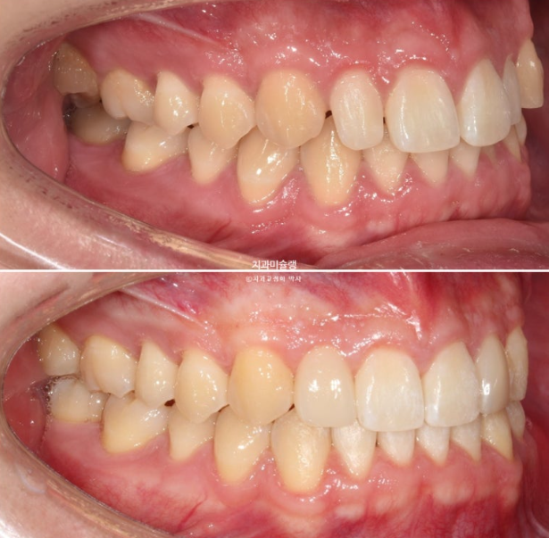 비대칭 비발치 거미스마일 잇몸미소 중심선 가위교합치료 무삭제 라미네이트 관련 이미지 25