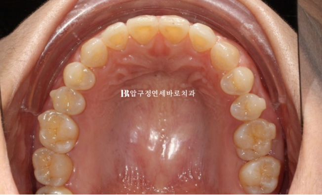 벌어진 치아 교정 인비절라인 라이트 무삭제 라미네이트 치료 관련 이미지 13