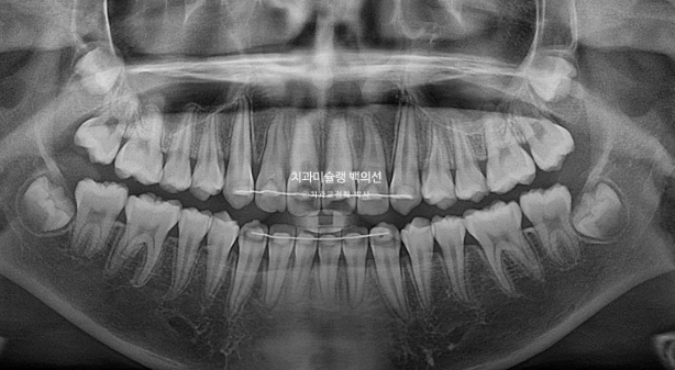 덧니 반대교합 과개교합 인비절라인 퍼스트 악궁확장 어린이 교정 관련 이미지 21