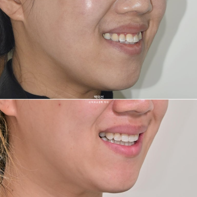 거미스마일 교정 돌출입 발치교정 입술부전 호두턱 치료기간 2년반 관련 이미지 24