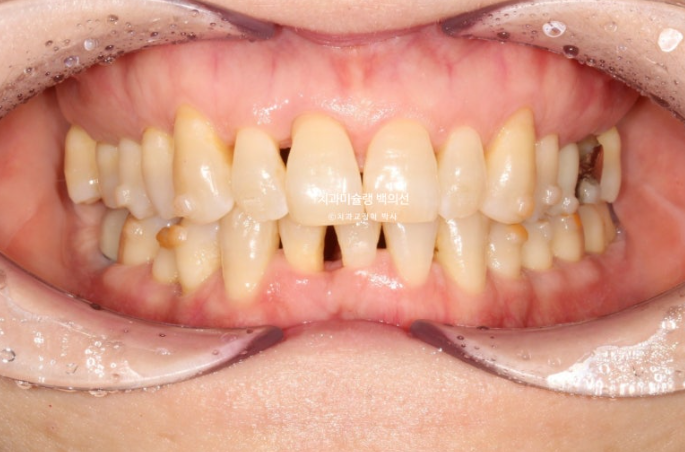 50대 치아교정 중년 발치교정 블랙트라이앵글 치료 후기 관련 이미지 8