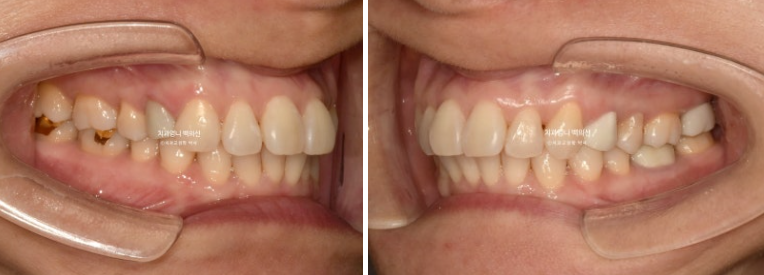 50대 캔팅 교합평면 기울어짐 덧니 교정 인비절라인 라이트 교정? 관련 이미지 3