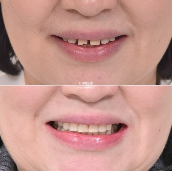 50대 치아교정 돌출 치아벌어짐 중년교정 관련 이미지 1