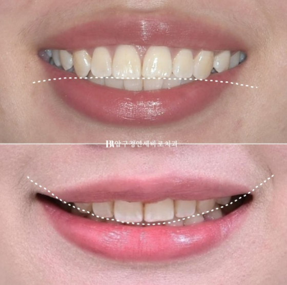 돌출입 교정 입동굴 클리피씨 교정 후기 관련 이미지 14
