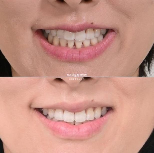 인비절라인 익스프레스 재교정 블랙트라이앵글 치간 삭제 치료기간 6개월 재제작 1회 관련 이미지 17