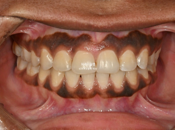 Extraction & re-orthodontics with Clippy-C, intrusion for dental implant. 관련 이미지 15