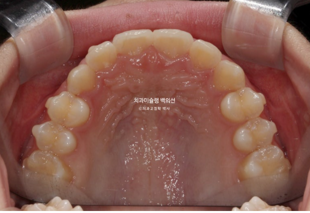 과개교합 인비절라인 모더레이트 컴프레헨시브 중심선 토끼이빨 관련 이미지 9