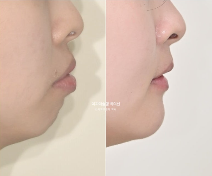돌출입 인비절라인 발치교정 거미스마일 잇몸미소 잇몸돌출 입술부전증 무턱 재교정 관련 이미지 22