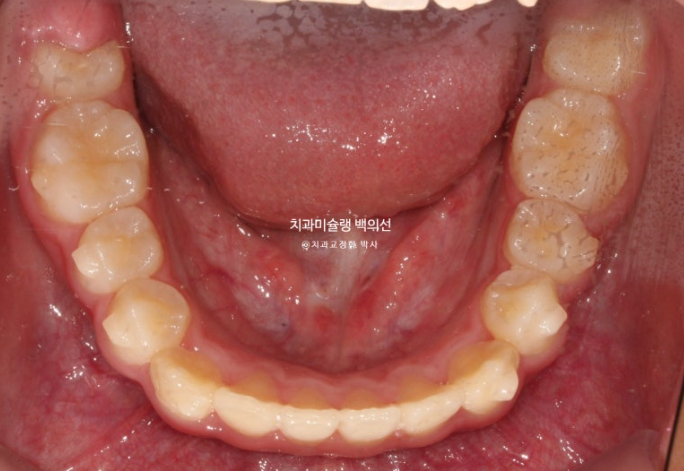 덧니 반대교합 과개교합 인비절라인 퍼스트 악궁확장 어린이 교정 치료 관련 이미지 9
