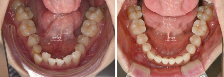 인비절라인 비발치 제2대구치 발치 사랑니 대체 교정 심한 덧니 교정 치료 관련 이미지 20