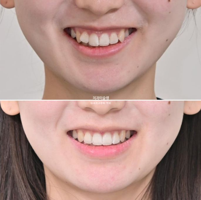 덧니 인비절라인 라이트 잇몸미소 거미스마일 중심선 블랙트라이앵글 관련 이미지 20