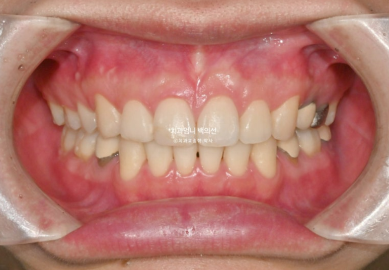 돌출입 발치 교정 인비절라인 후기 미니스크류 관련 이미지 15