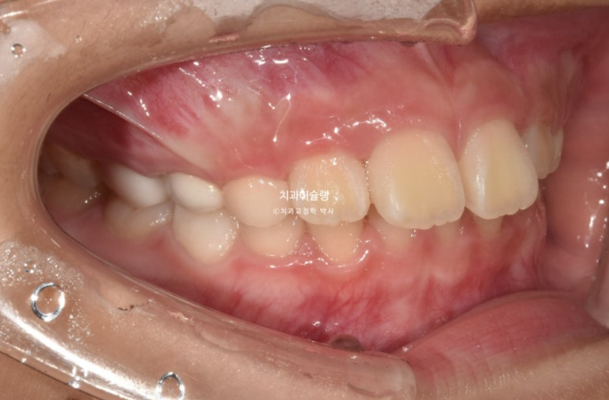 어린이 돌출입 교정 무턱 투명교정 인비절라인 퍼스트 관련 이미지 3