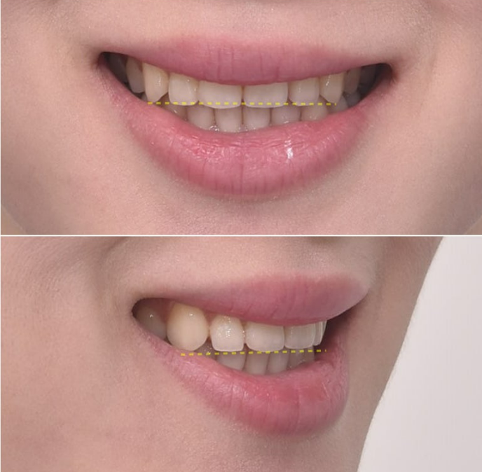 스마일라인 개선 무삭제 라미네이트 실제 두께 ? 관련 이미지 5