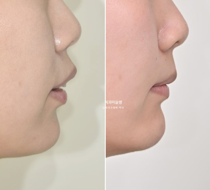 돌출입 덧니 발치 교정 인비절라인 교정 후기 관련 이미지 28