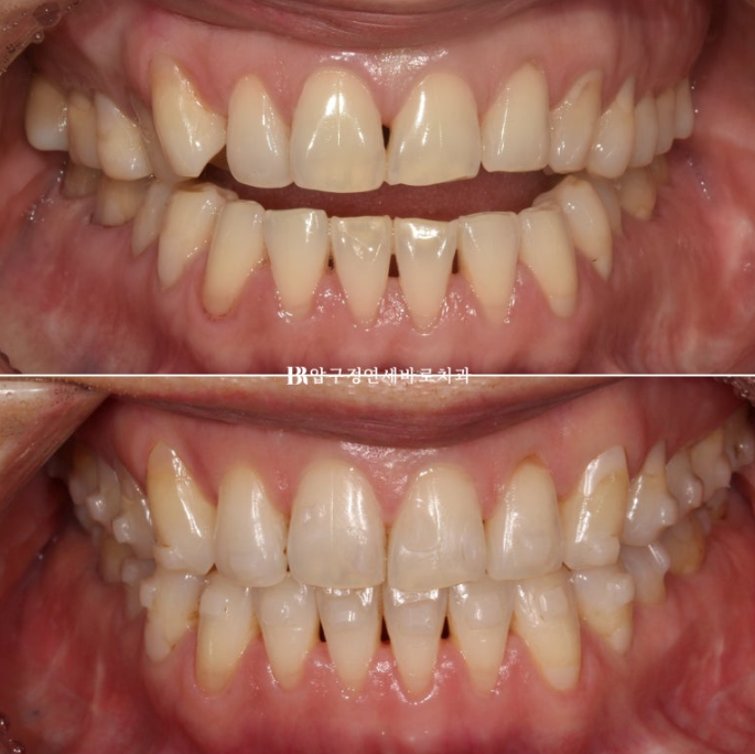 50대 인비절라인 개방교합 합입교정 미니스크류 관련 이미지 1