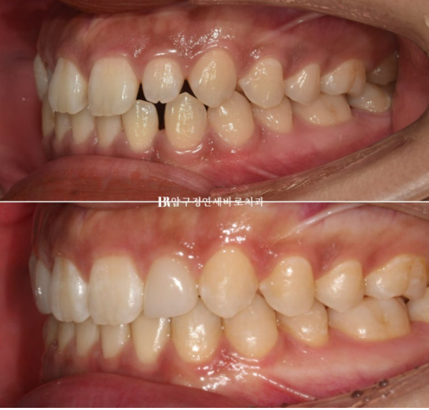 왜소치 인비절라인 라이트 교정 / 무삭제 라미네이트 젤라미 관련 이미지 11