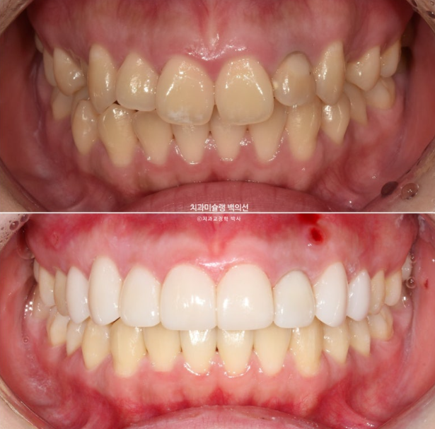 잇몸미소 인비절라인 거미스마일 토끼이빨 교정 무삭제 라미네이트 반대교합 치료 후기 관련 이미지 18