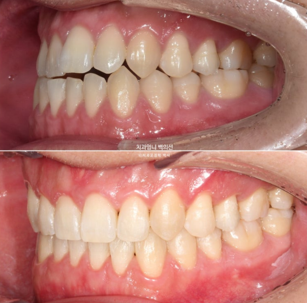 MSE Palatal Expansion Invisalign Underbite Correction, Non-Surgical image 22