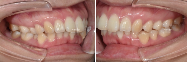 돌출입 덧니 발치 교정 인비절라인 교정 후기 관련 이미지 4